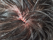 Grapa medico encierro ambulancia